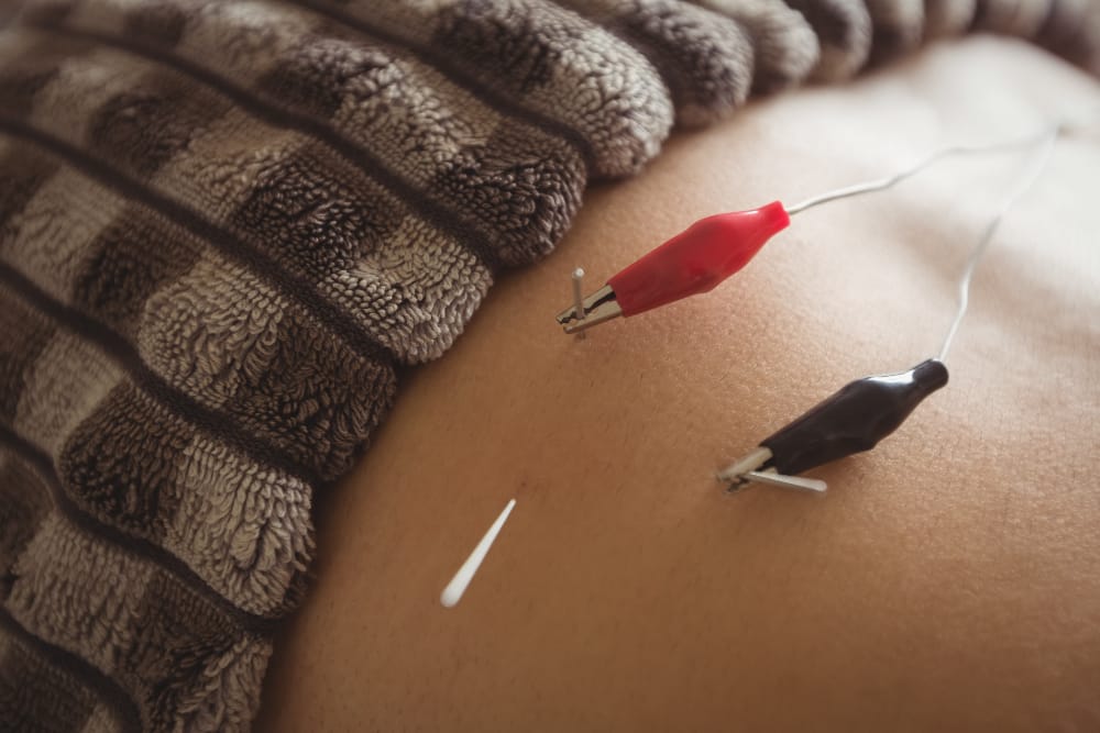 764435 - Javier Bravo Fisioterapia - Hunter Magazine Acupuncture treatment: a small needle in bare skin with red and black clip electrodes nearby, a brown towel in the background.