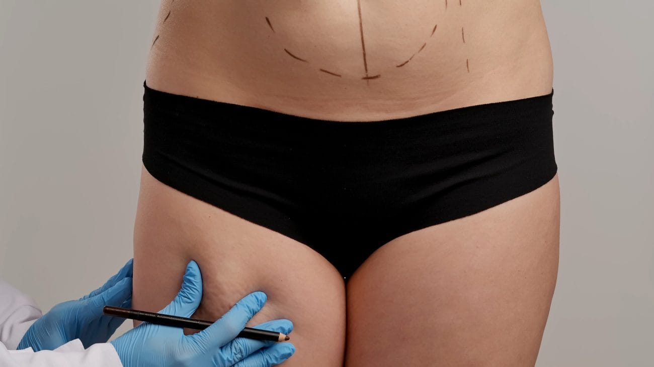 Medical professional with blue gloves marking a patient’s midsection for body contouring using a marker on the abdomen and upper thigh area.